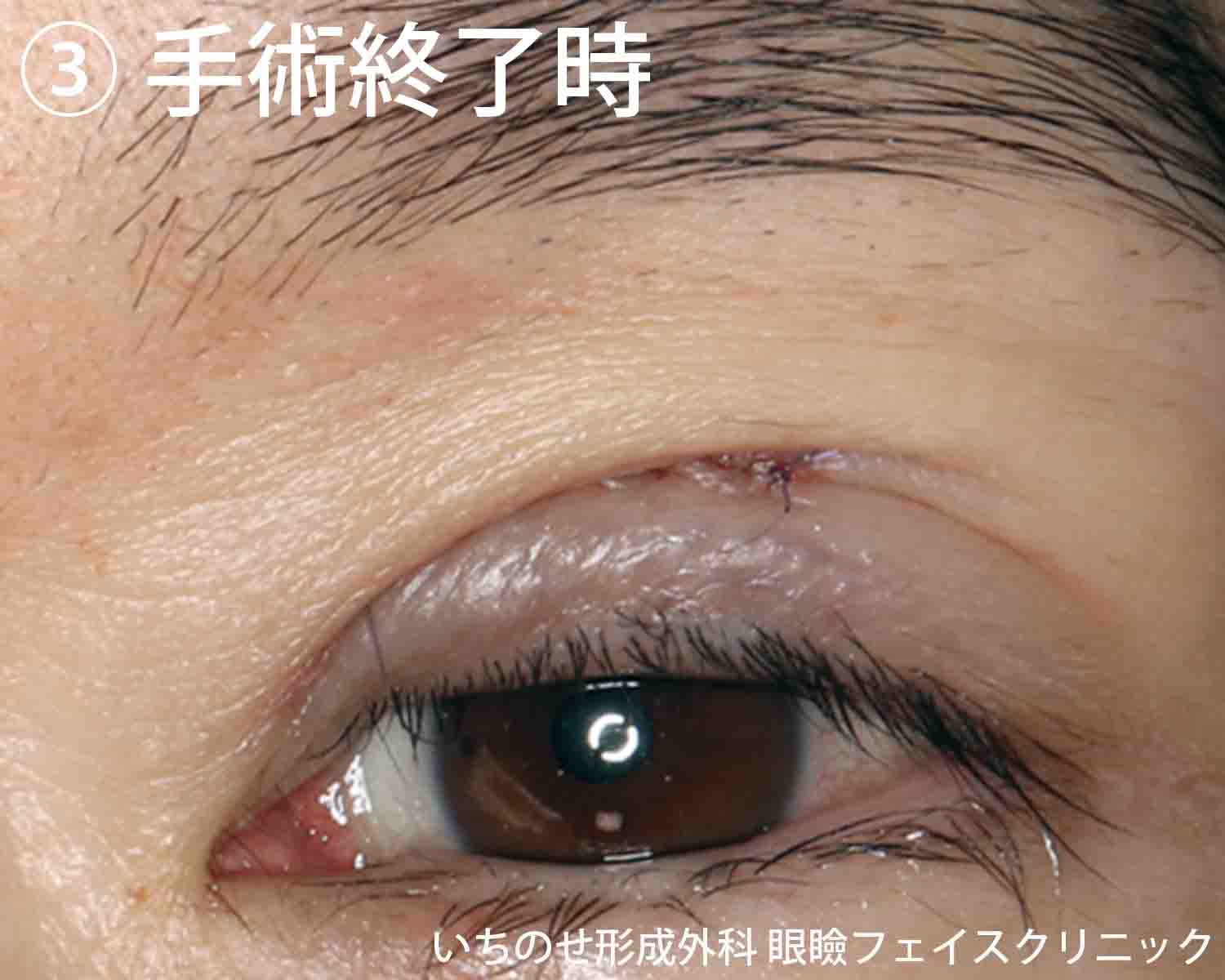 部分切開法眼瞼下垂手術の症例写真 手術直後